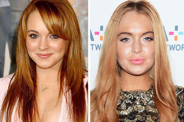 Lindsay Lohan (labios y botox)